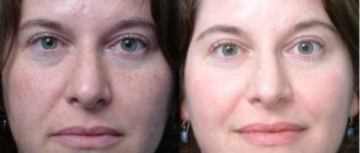 Pores become clogged - skin condition worsens