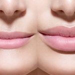 Preparations for lip augmentation