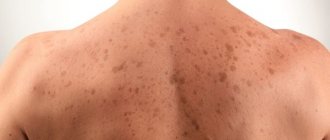 Causes and treatment of brown spots on the skin: on the back, legs, arms, stomach. Photo 