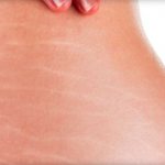 causes of stretch marks on the buttocks