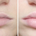 An example of lip augmentation using fillers. Comparison with tattoo 