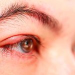 signs of the upper eyelid