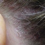 Progressive stage of psoriasis on the scalp