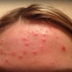 Pimples and oily skin on the forehead. Causes of acne on the forehead in women 