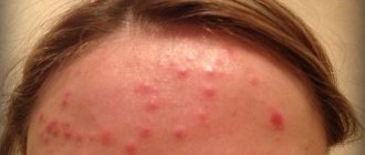 Pimples and oily skin on the forehead. Causes of acne on the forehead in women 