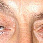 Ptosis - drooping of the upper eyelid