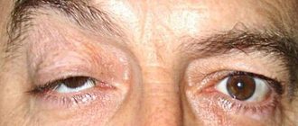 Ptosis - drooping of the upper eyelid