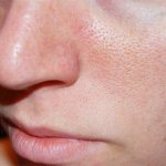 enlarged pores on the face