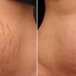 stretch marks after childbirth and their removal
