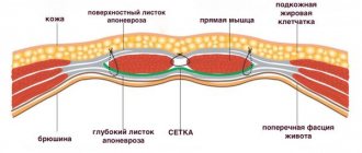 Ретромускулярное расположение сетчатого имплантата