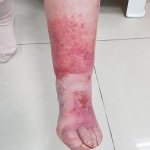Erysipelas on our patient’s leg