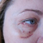 Scars after lower eyelid blepharoplasty