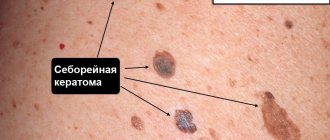 seborrheic keratoma on the skin