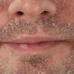 Seborrheic dermatitis on the face of an adult