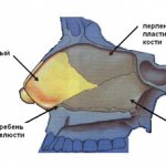 Septoplasty - correction of the nasal septum