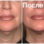 Smoothing wrinkles on the neck with botulinum toxin preparations