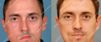 Symptoms of facial asymmetry