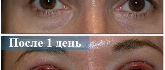 How long does it take to fully recover after blepharoplasty?