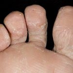skin peeling off toes