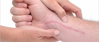 Remedies for scars: top 7 best