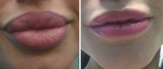 removing biopolymer gel from lips