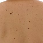 Removing birthmarks and port-wine stains