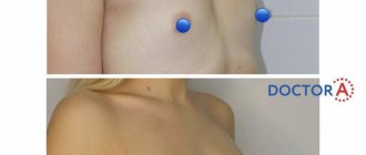 Увеличение груди: фото до и после (первичная реабилитация)
