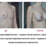 Breast augmentation Ryazan