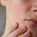 Types of acne on the chin