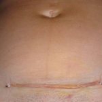 Recovery and care of sutures after cesarean section