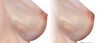 Inverted nipple - causes and what to do