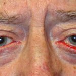 Eversion (ectropion) of the lower eyelid