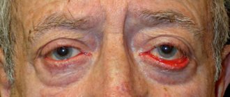 Eversion (ectropion) of the lower eyelid