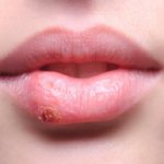 Lip disease