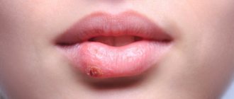 Lip disease