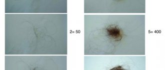 Hair diseases - degrees of hair loss