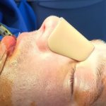 Protective plate for the nose after rhinoplasty